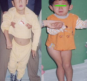 脑瘫儿童的言语障碍训练方法有哪些